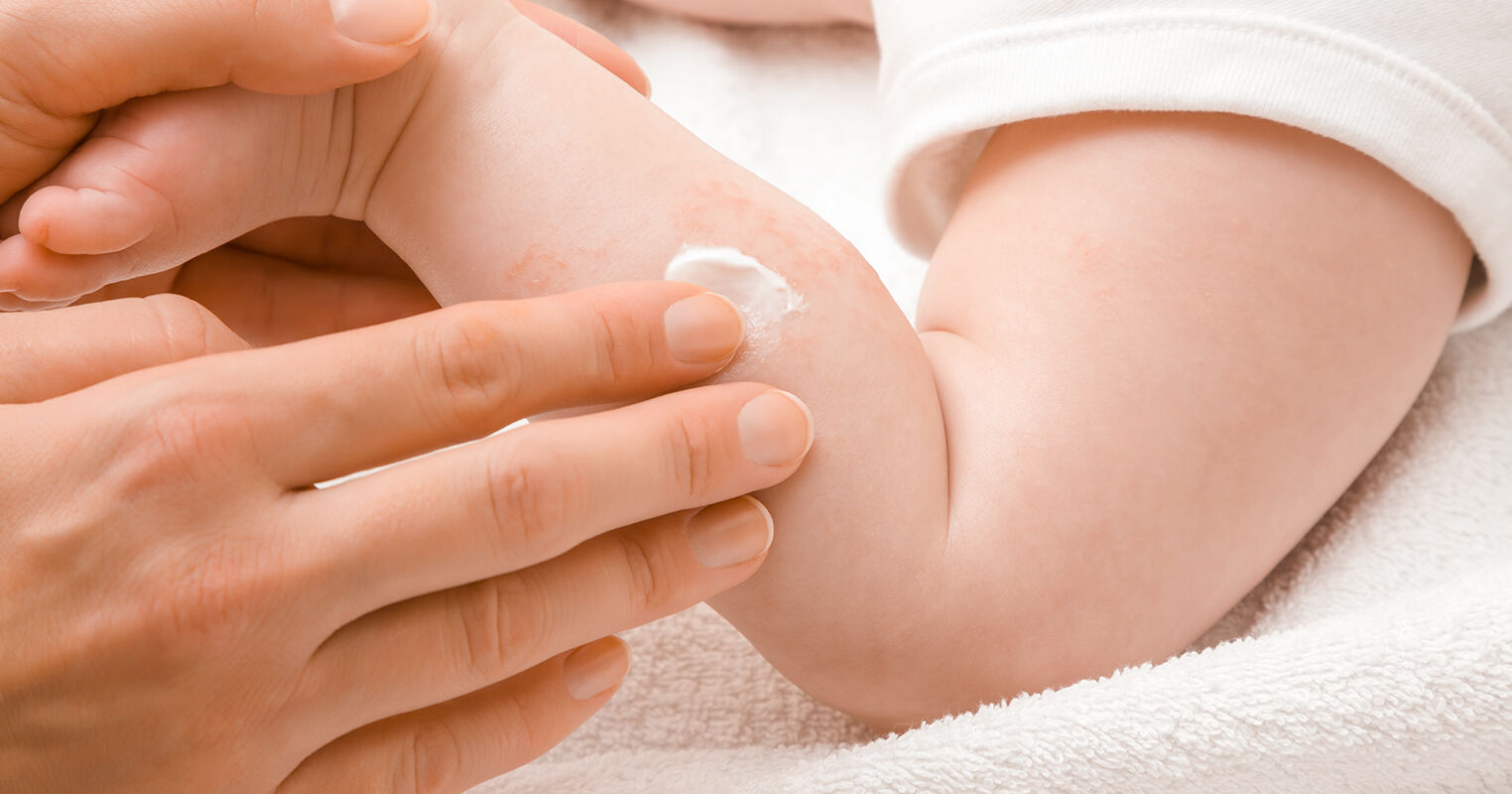Understanding_Baby_Eczema-2